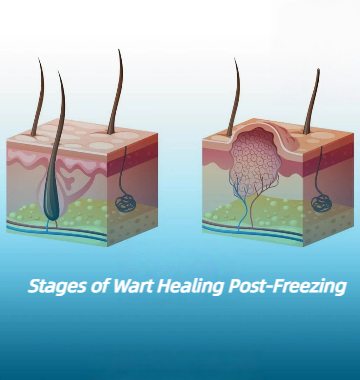 Stages of Wart Healing After Freezing: Warts Recovery with Cryotherapy